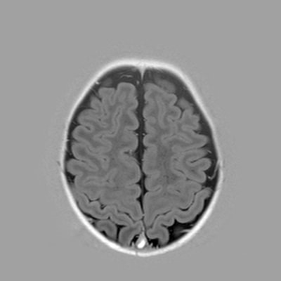 2 months - MRI Atlas of Normal Myelination