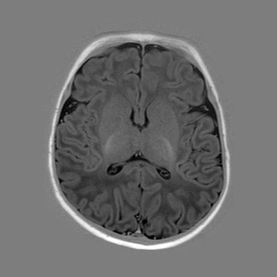 6 weeks - MRI Atlas of Normal Myelination