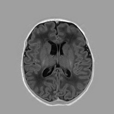 Newborn - MRI Atlas of Normal Myelination