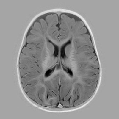 7 months - MRI Atlas of Normal Myelination