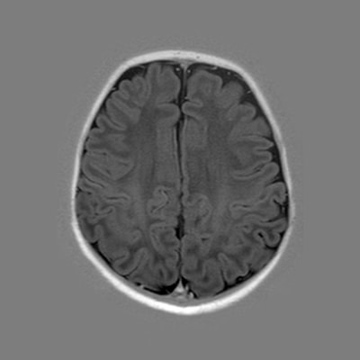 6 weeks - MRI Atlas of Normal Myelination