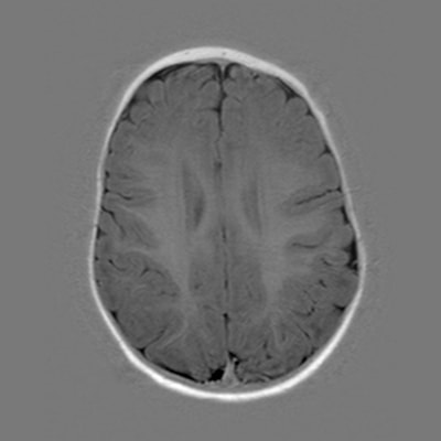 6 months - MRI Atlas of Normal Myelination